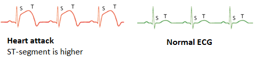 Figure 3: ECG of a heart attack