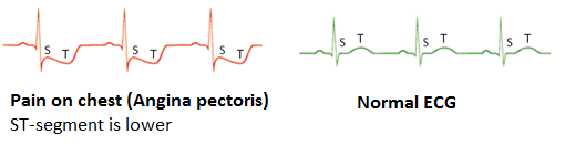 Figure 5: ECG of pain on chest